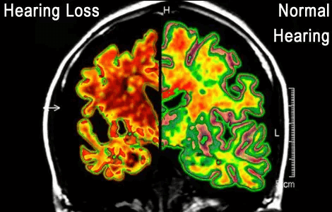 This is your brain on hearing loss